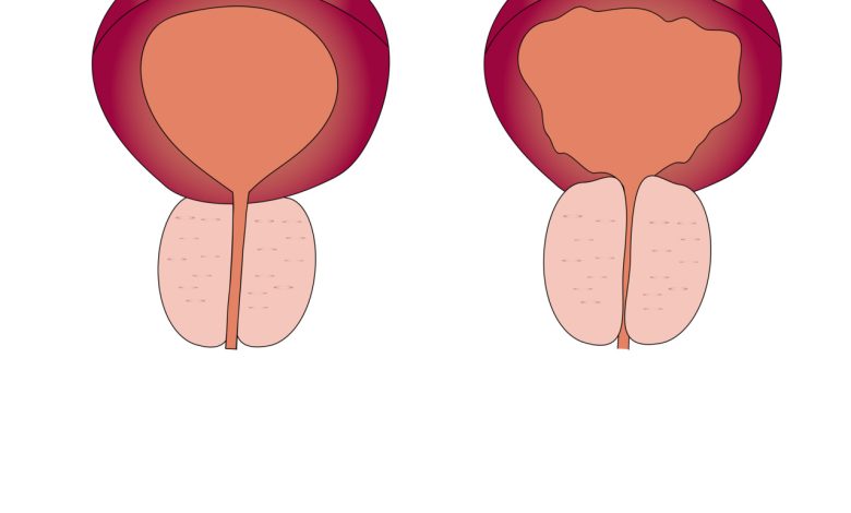 Hiperplasia prostática benigna