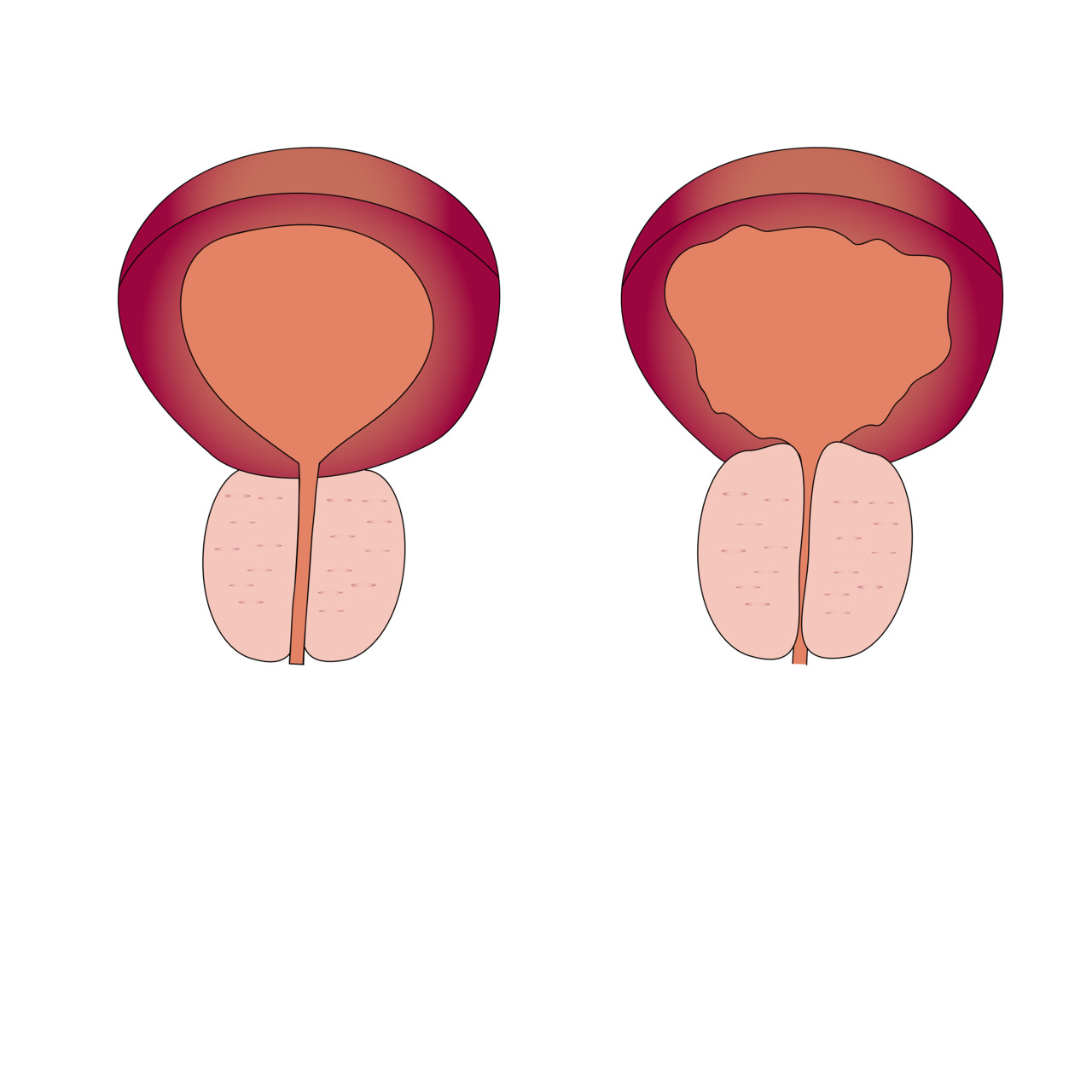 Hiperplasia prostática benigna