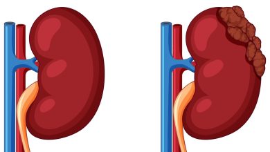 Câncer renal