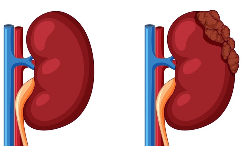 Câncer renal