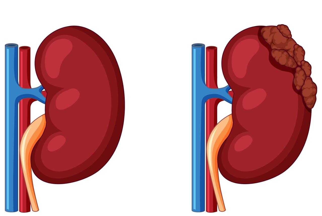 Câncer renal