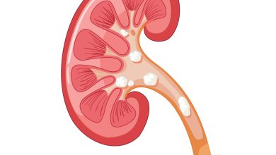 Cálculo renal