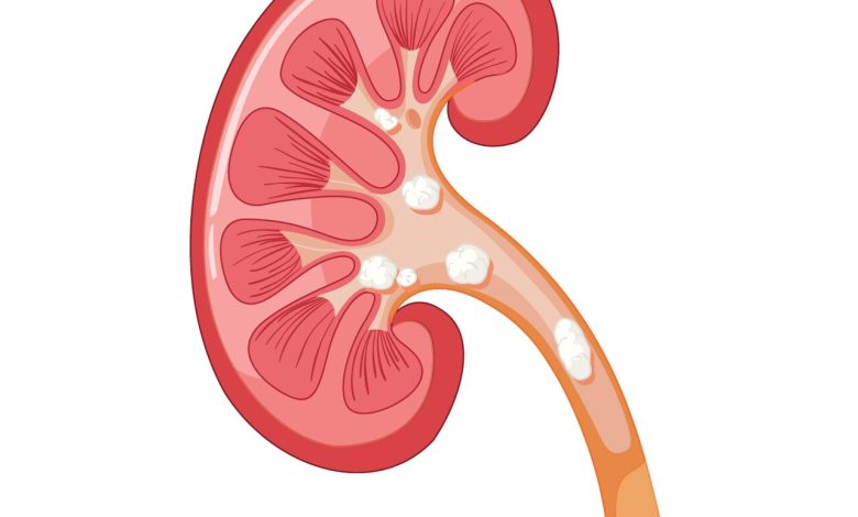Cálculo renal