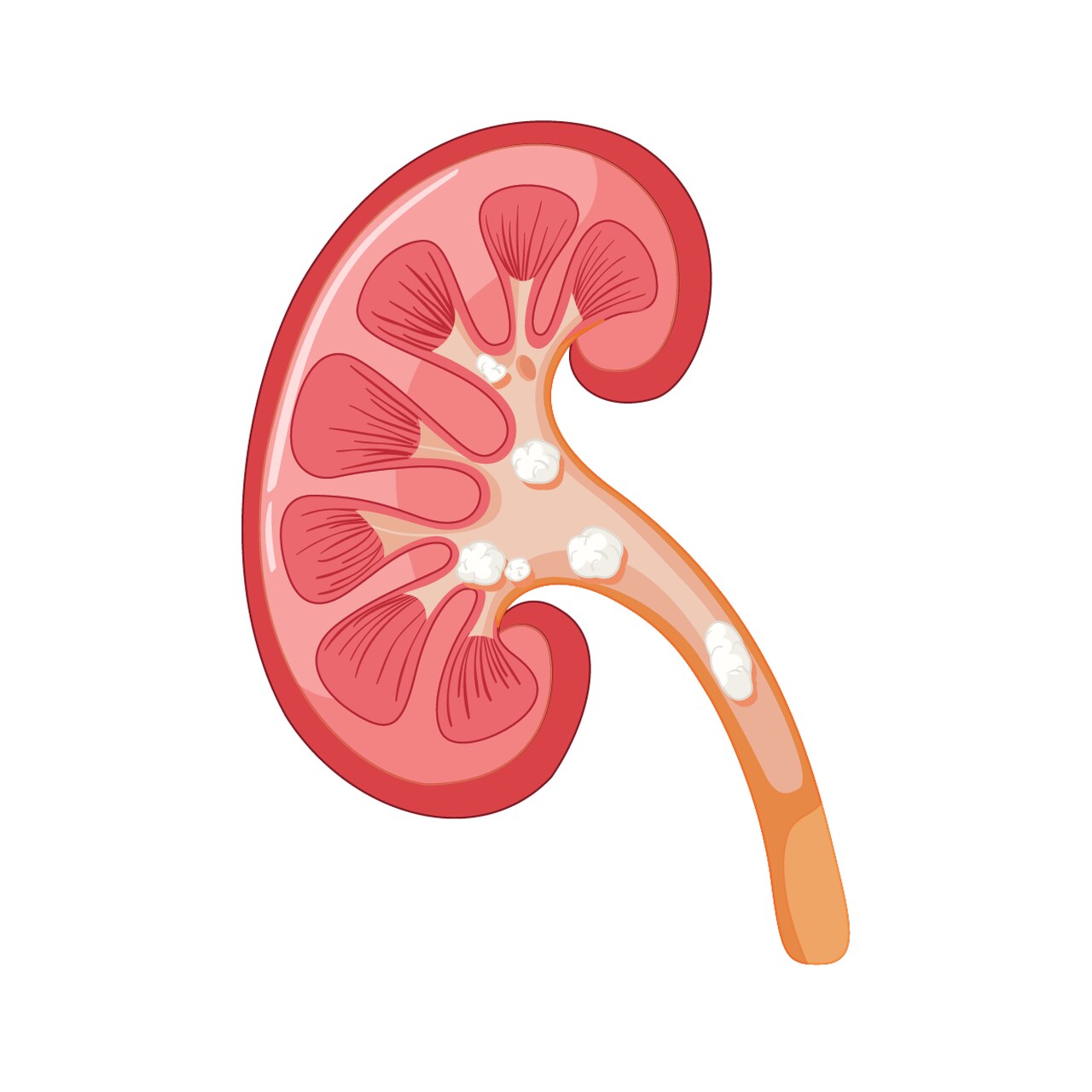 Cálculo renal