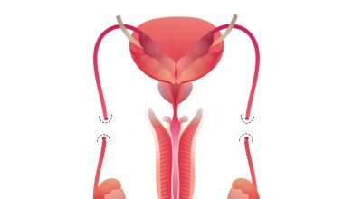 Vantagens e desvantagens da vasectomia