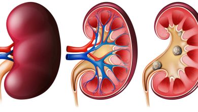 Cálculo ureteral: sintomas e tratamentos