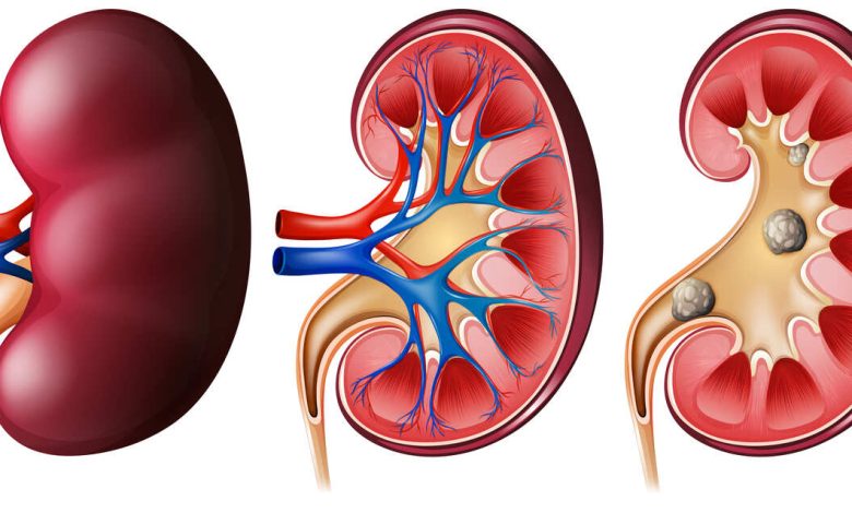 Cálculo ureteral: sintomas e tratamentos