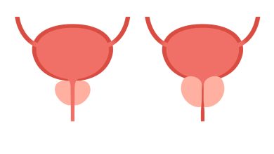 Como é feita a cirurgia ressecção transuretral da próstata?