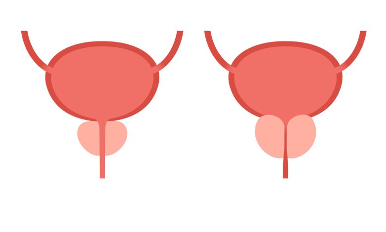 Como é feita a cirurgia ressecção transuretral da próstata?