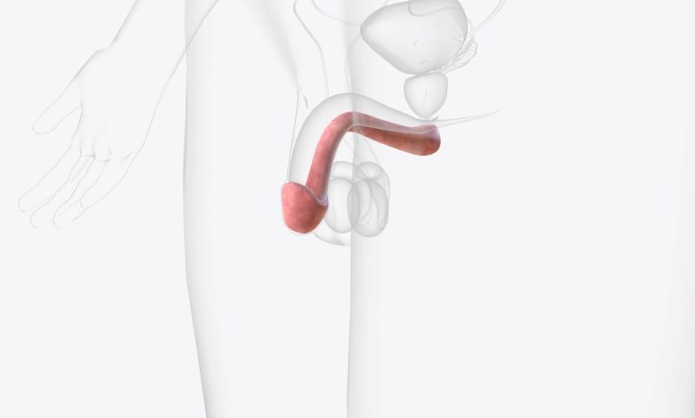 Doença de Peyronie: como tratar?