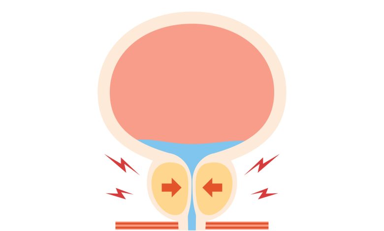 Conheça a cirurgia a laser altamente eficaz no tratamento da hiperplasia benigna da próstata