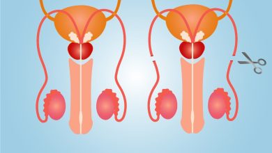 Vasectomia prejudica a vida sexual do homem