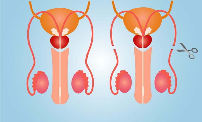 Vasectomia prejudica a vida sexual do homem