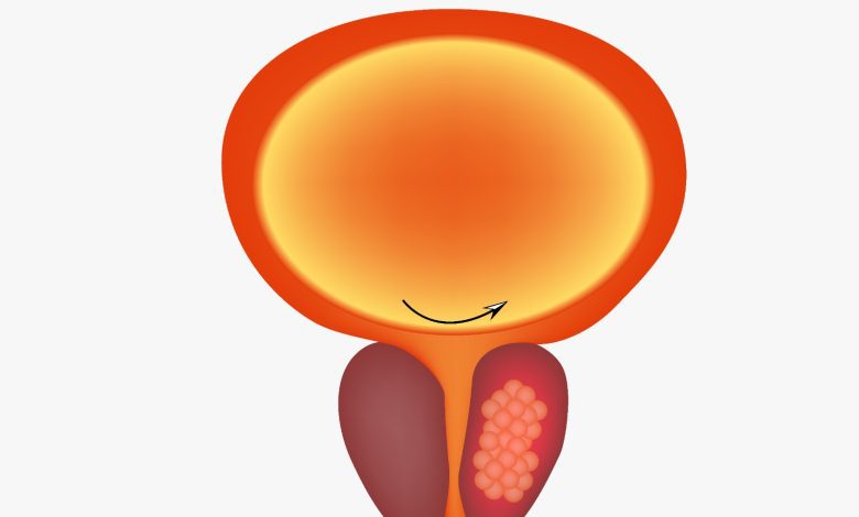 Tamanho da próstata e câncer: existe relação entre esses fatores?