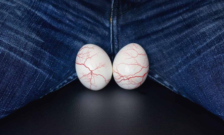 Mitos e verdades sobre a varicocele