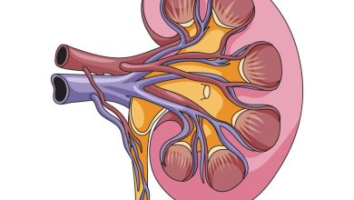 Nefrolitotripsia Percutânea o que é e quando é indicada